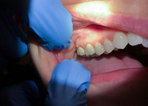 Best Emergency Care for Gum Disease in Myers Corner, NY