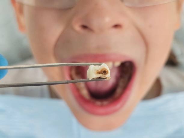 Best Emergency Wisdom Tooth Extraction in Myers Corner, NY